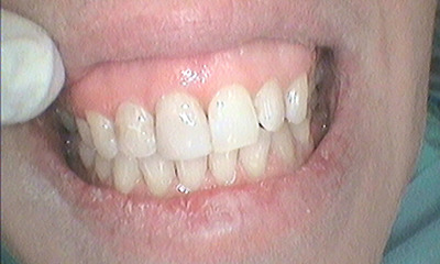 After treatment - Composite Resin Repair for Chipped Front Tooth