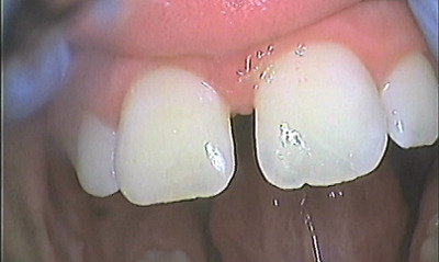 After treatment - Rebonding of Broken Front Teeth