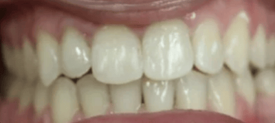 Teen-Invisalign-Treatment-After-Image