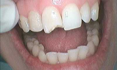 Before treatment - Composite Resin Repair for Chipped Front Tooth