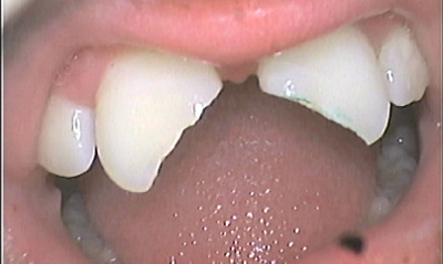 Before treatment - Rebonding of Broken Front Teeth