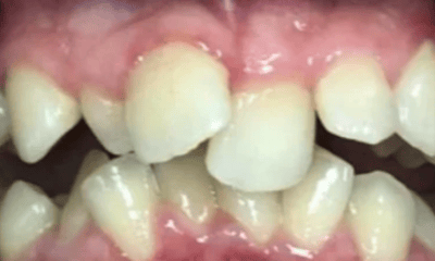 Teen-Invisalign-Treatment-Before-Image